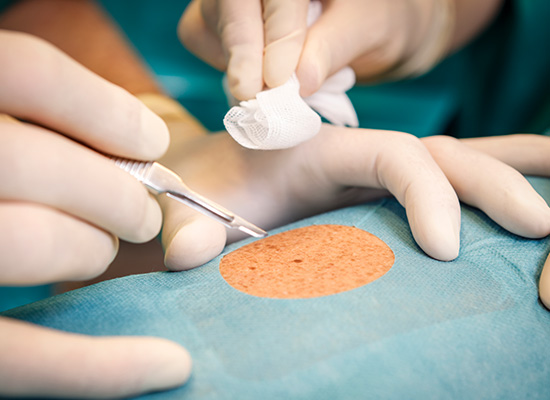 Bild von Skalpell vor Bauchdecke